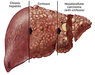  Máj Hepatitis C