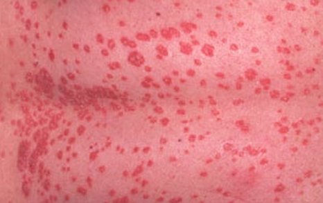 psoriasis