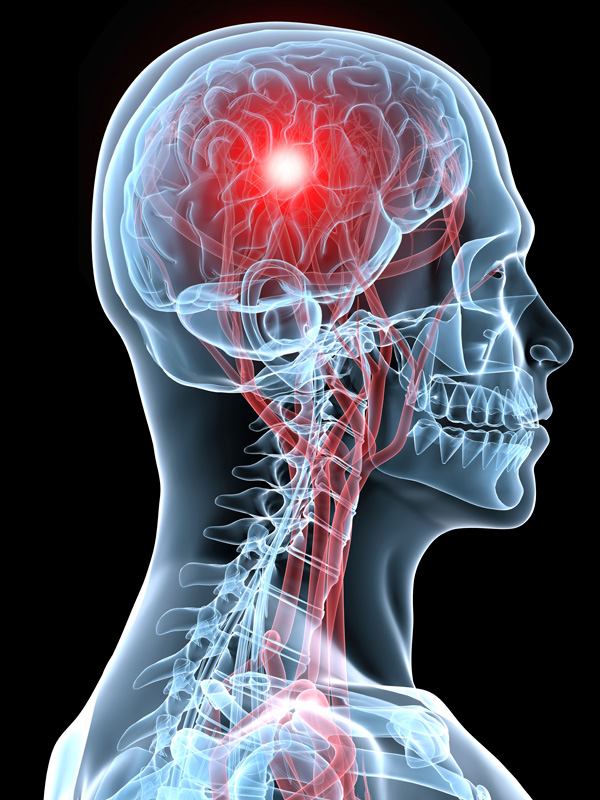 stroke agyi infarktus