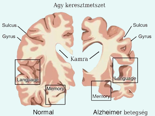 alzheimer-kór