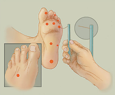 neuropathia