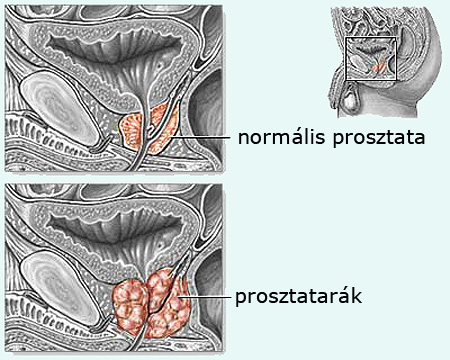 prosztatarák