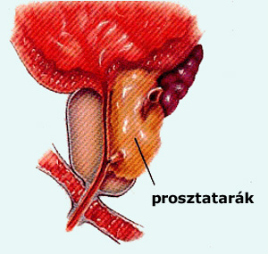 prosztatarák
