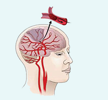 iszkémiás stroke