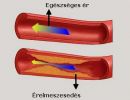 Érelmeszesedés
